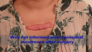 Chest Keloids  Mistakes to Avoid [upl. by Eelyah]