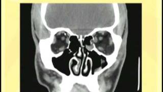 Ophthalmology Lecture  Eye Anatomy Part 3 [upl. by Orland]